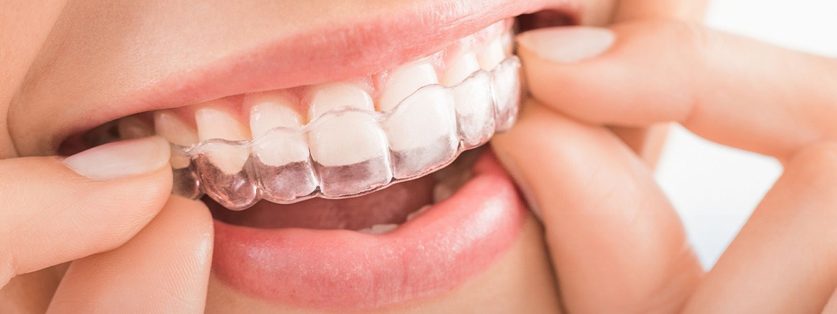 Invisalign treatment in dubai